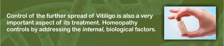 Homeopathic Treatment for Vitiligo