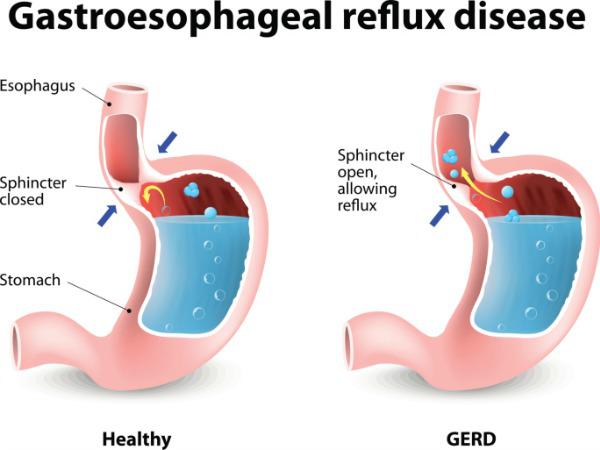 Homeopathic treatment for Gastro-esophageal reflux