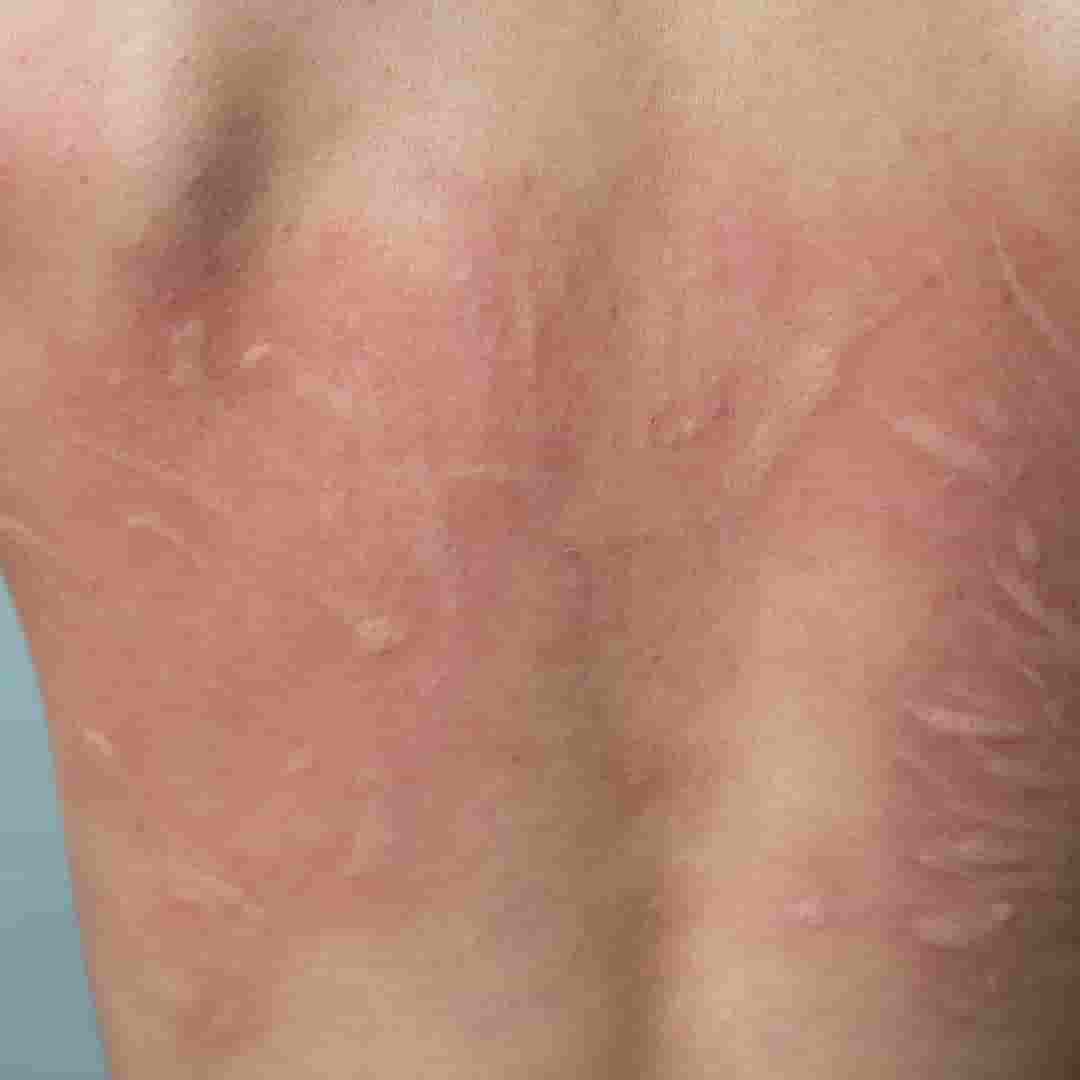 A case of urticaria successfully treated with individualized homeopathy.