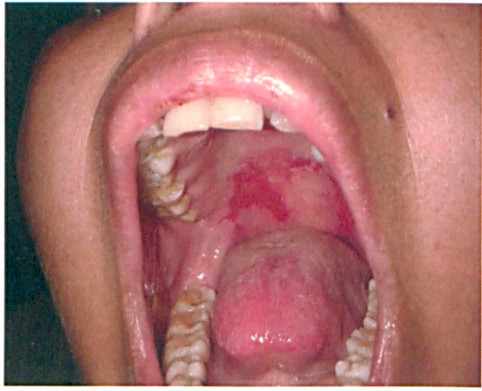 Pemphigus vulgaris