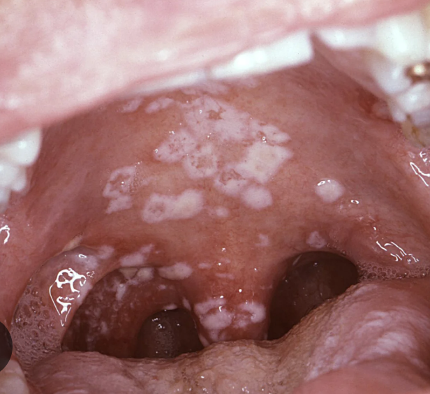 Candidiasis