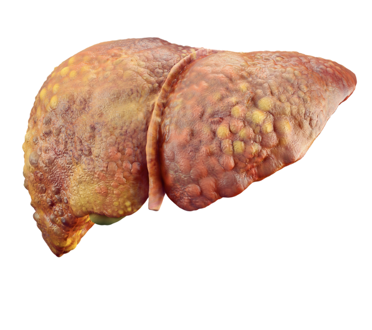 Fatty liver
