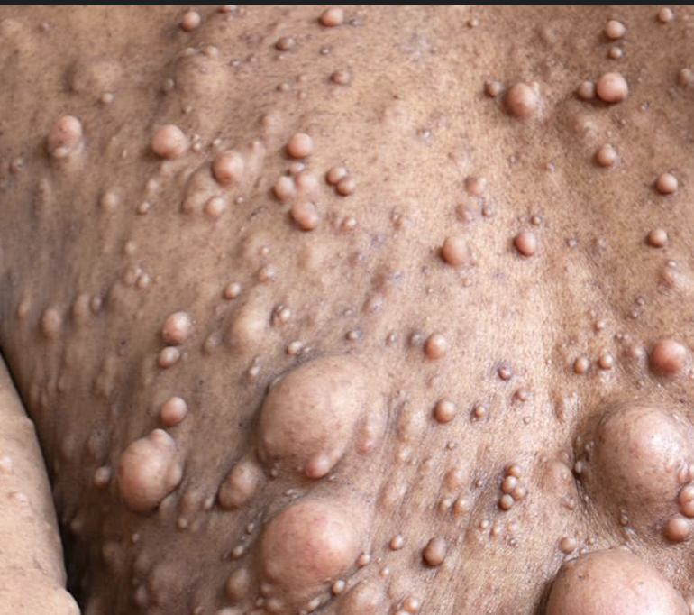 Neurofibromatosis and homeopathy