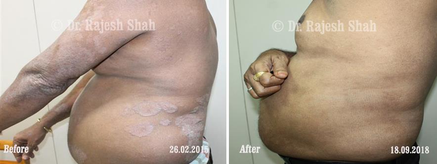 Psoriasis Before and After Case Photo