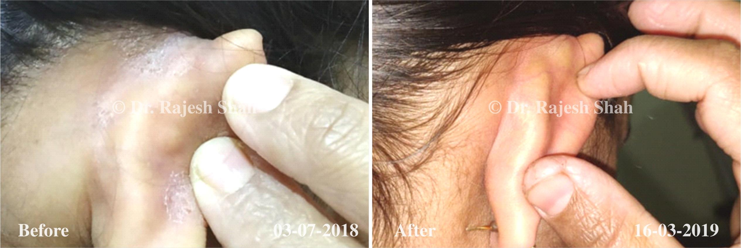 Psoriasis Before and After Case Photo