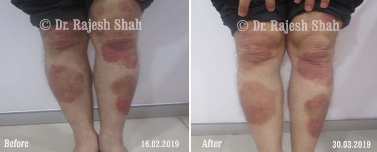 Psoriasis Before and After Case Photo