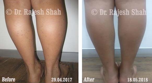 Lichen Planus Before and After Case Photo