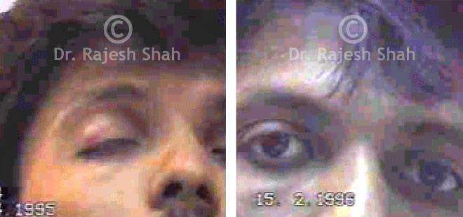 Lumbar Spondylitis .Before and After Case Photo