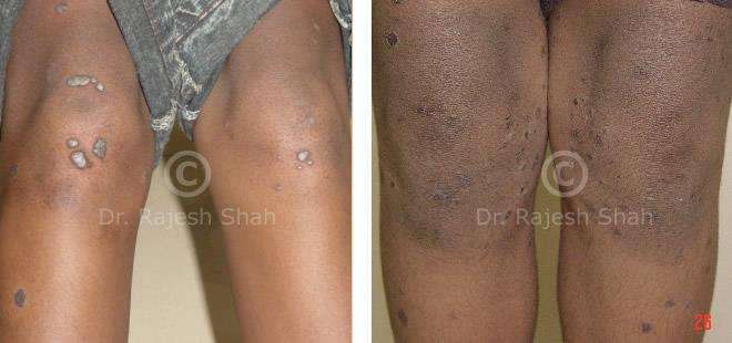 Lichen Planus Before and After Case Photo