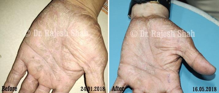 Atopic Dermatitis Before and After Case Photo