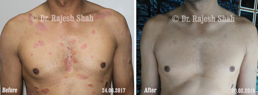 Psoriasis Before and After Case Photo
