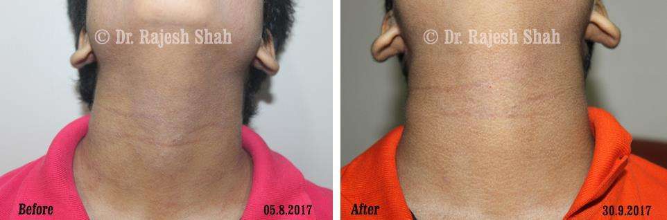 Atopic DermatitisBefore and After Case Photo