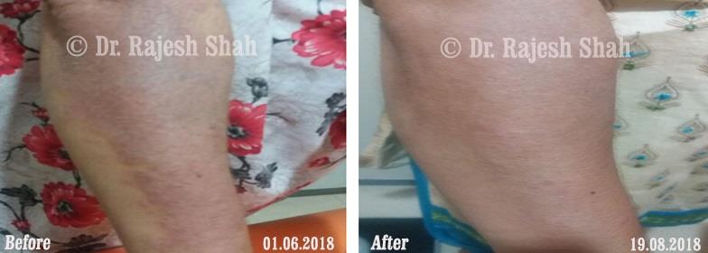 Psoriasis Before and After Case Photo