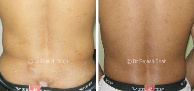 Psoriasis Before and After Case Photo