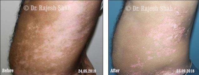 Vitiligo Before and After Case Photo