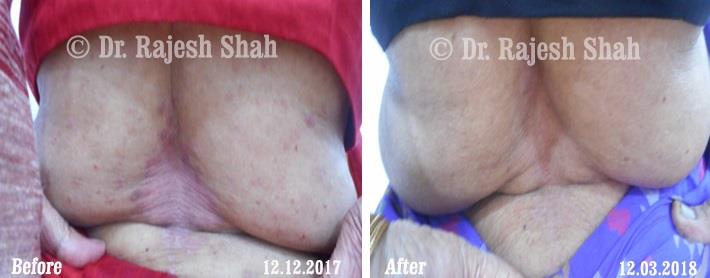 Psoriasis Before and After Case Photo
