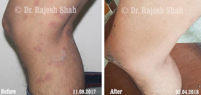 Lichen Planus Before and After Case Photo