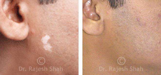 Vitiligo Before and After Case Photo