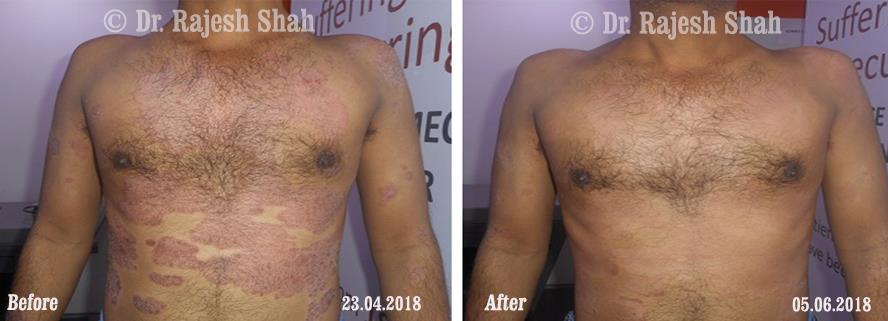 Psoriasis Before and After Case Photo