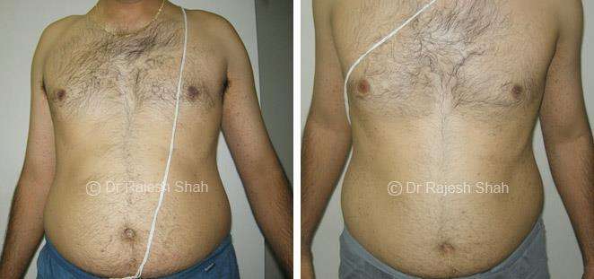 Lichen Planus Before and After Case Photo