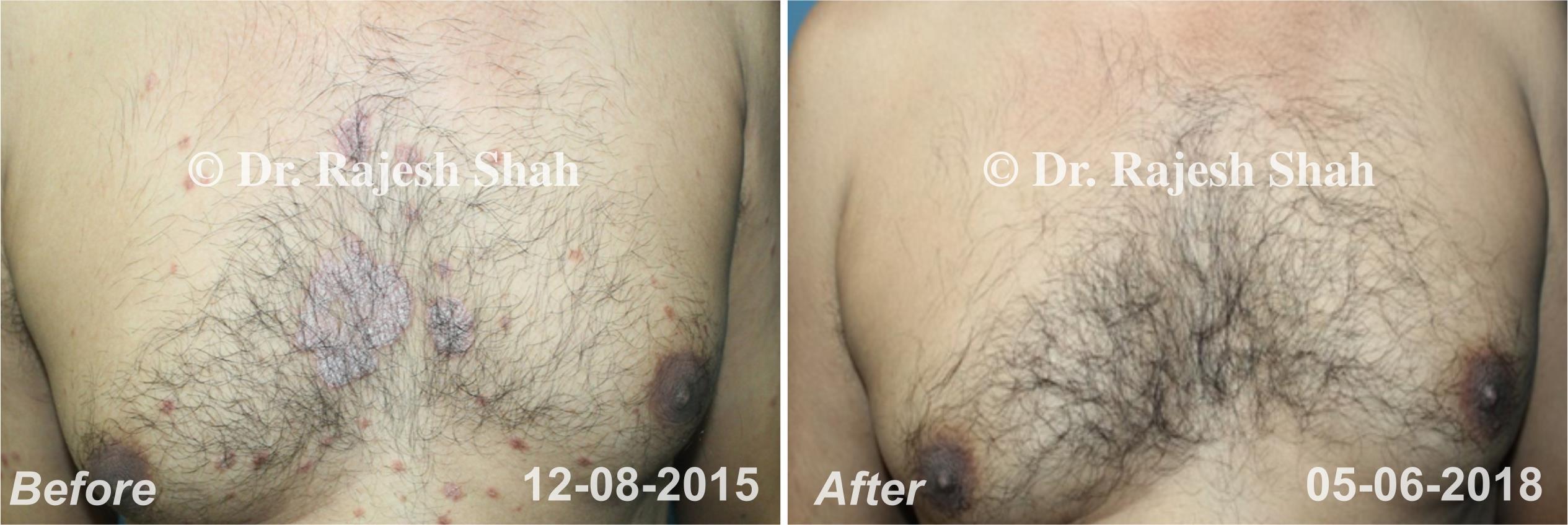 Psoriasis Before and After Case Photo