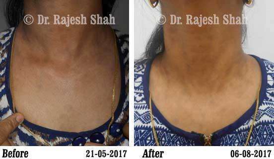 Lichen PlanusBefore and After Case Photo