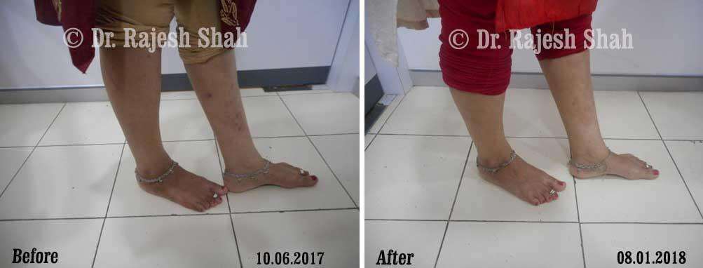 Psoriasis Before and After Case Photo