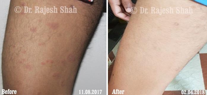 Lichen Planus Before and After Case Photo