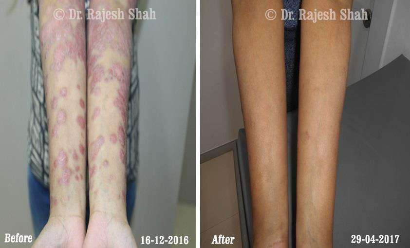 Psoriasis Before and After Case Photo