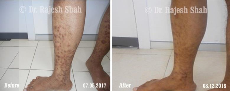 Lichen Planus Before and After Case Photo