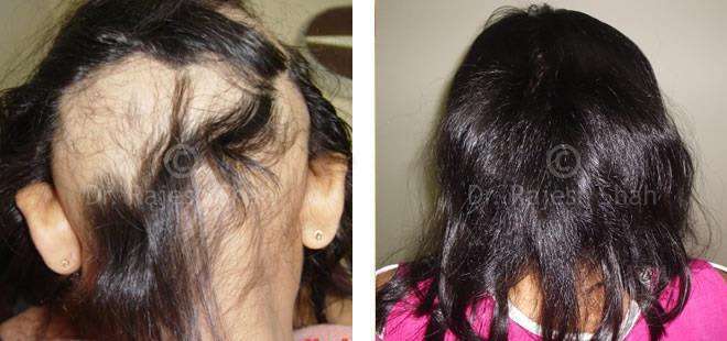 Alopecia Areata Before and After Case Photo