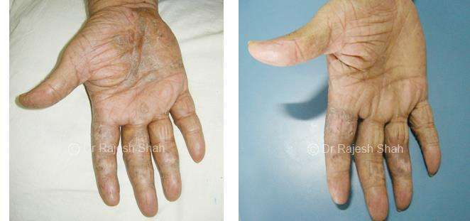 Psoriasis Before and After Case Photo