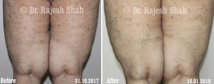 Lichen Planus Before and After Case Photo