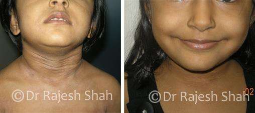 Eczema Before and After Case Photo