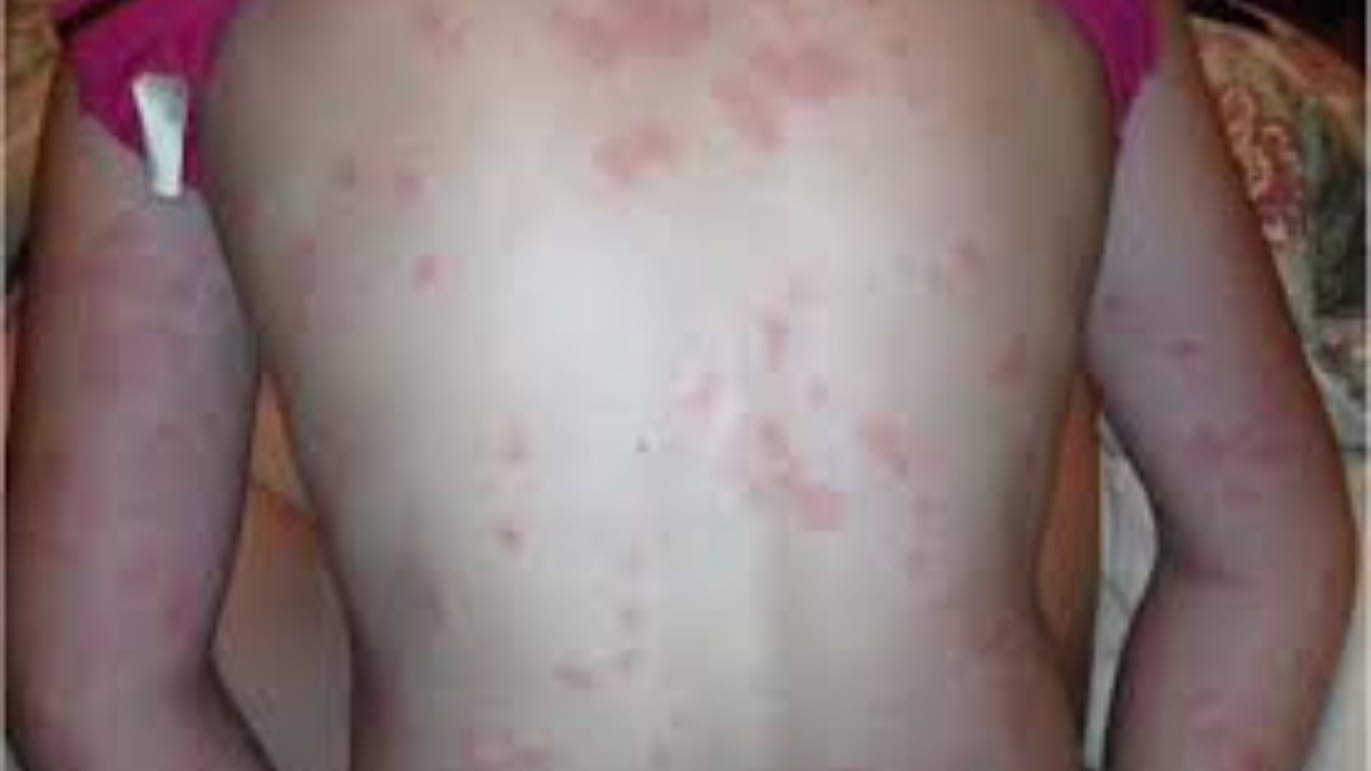 12-Year-Old Boy Overcame Chronic Urticaria Naturally