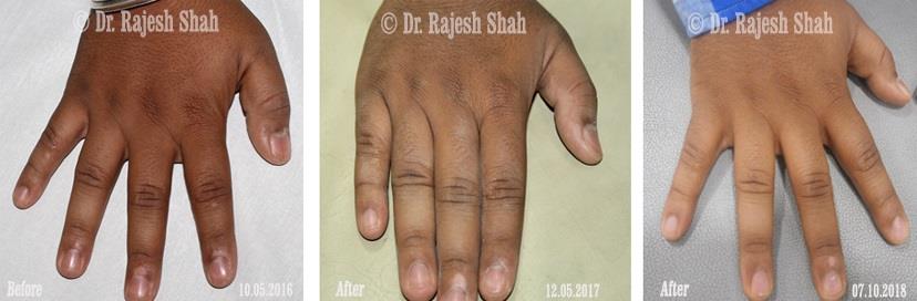 Vitiligo Before and After Case Photo