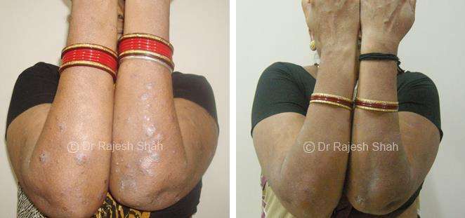 Psoriasis Before and After Case Photo