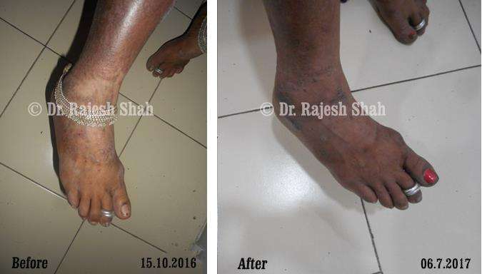 Psoriasis Before and After Case Photo