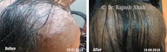 Seborrhoeic Dermatitis Before and After Case Photo