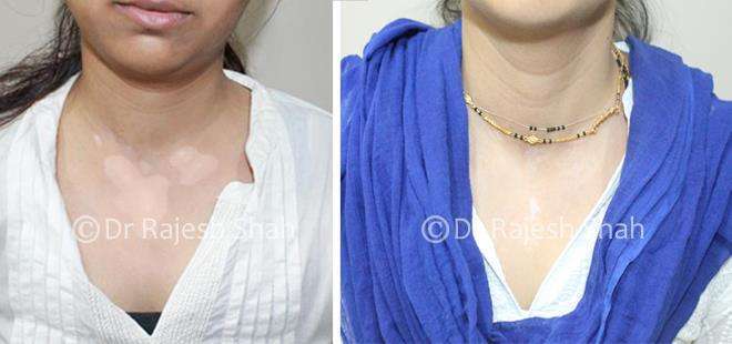 Vitiligo Before and After Case Photo