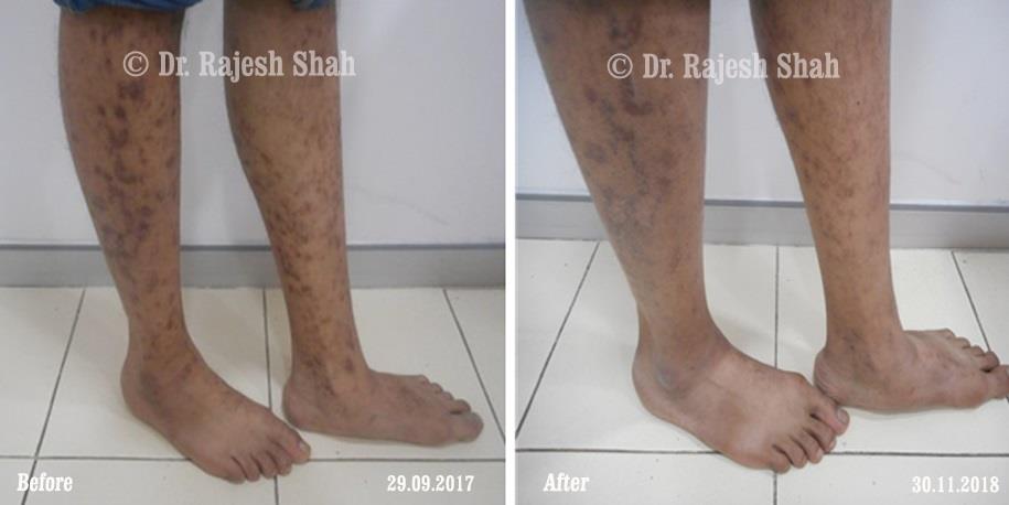 Lichen Planus Before and After Case Photo