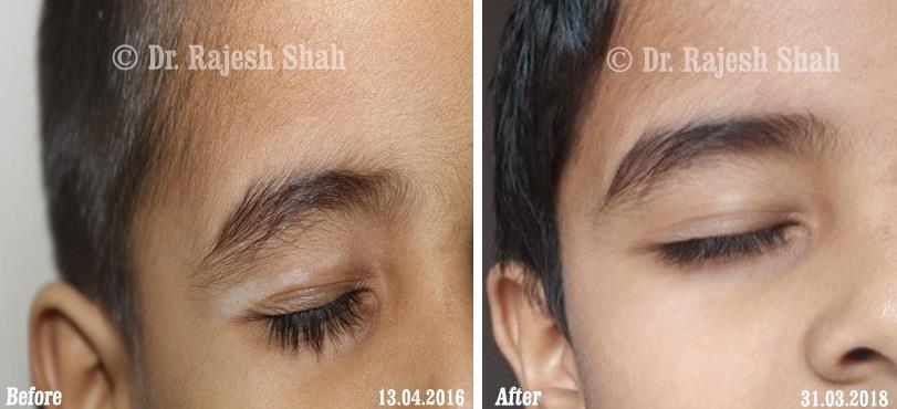 Vitiligo Before and After Case Photo