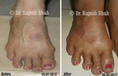 Granuloma Annulare Before and After Case Photo