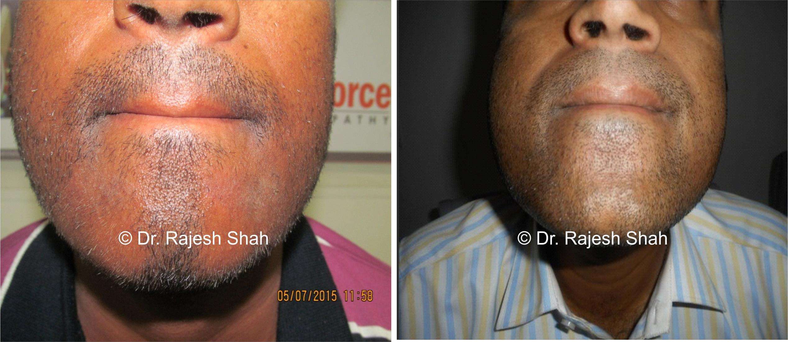 Alopecia Areata Before and After Case Photo