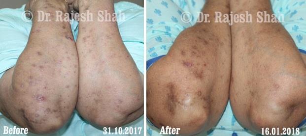 Lichen Planus Before and After Case Photo