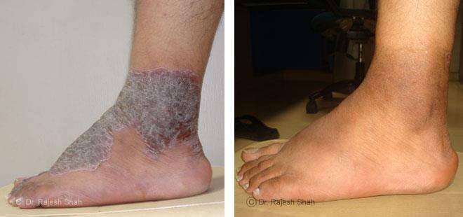 Psoriasis Before and After Case Photo