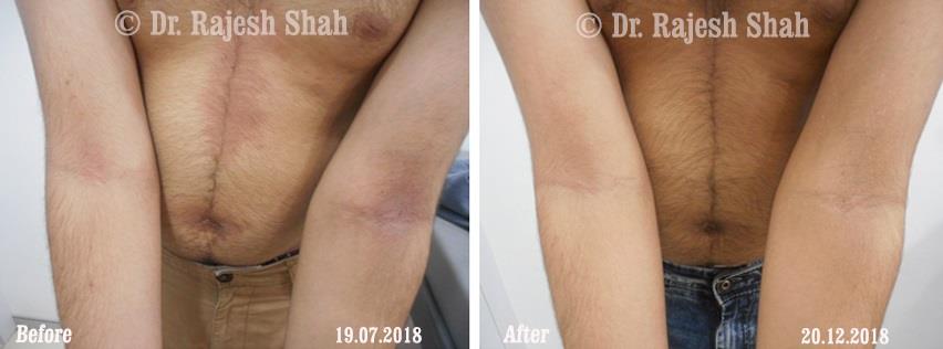 Atopic Dermatitis Before and After Case Photo