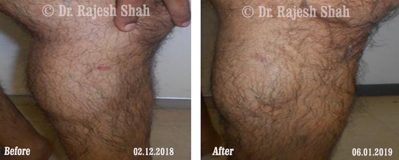 Psoriasis Before and After Case Photo