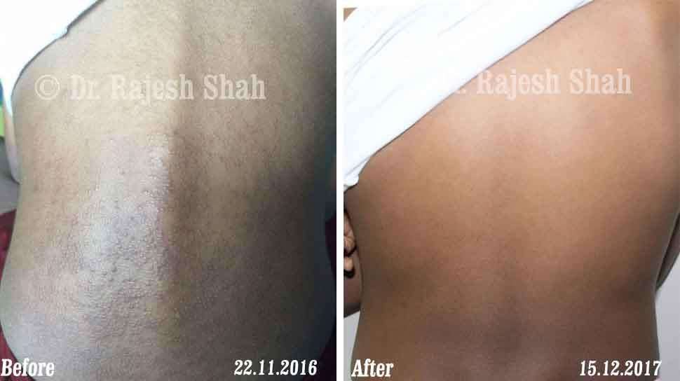 Eczema Before and After Case Photo