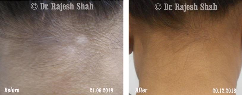 Vitiligo Before and After Case Photo